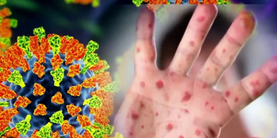 Hand with measles next to icon of the disease. 
