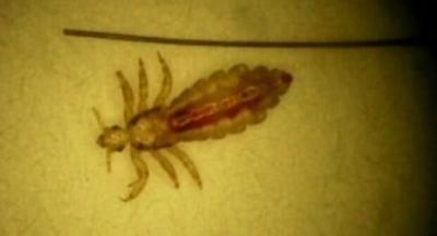 Head Lice Could be Worse This School Year