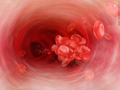 blood clot