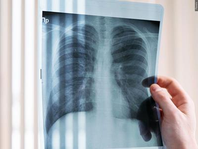 Lung X-Ray