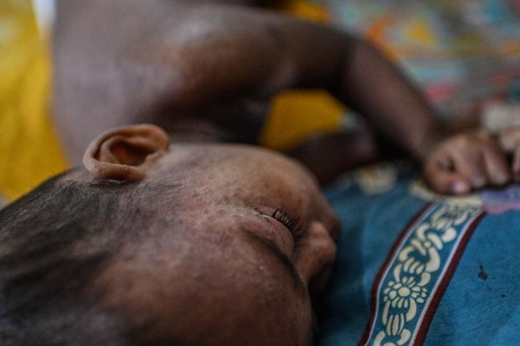 APOTOPIX Bangladesh Measles Outbreak