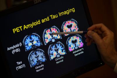 Be Well-Alzheimer's-Blood Tests