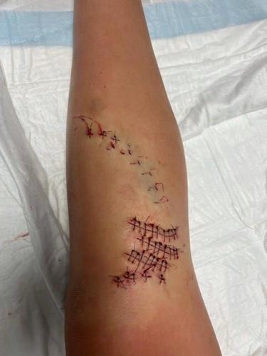 Girl, 12, Recovering After Apparent Shark Bite in Ocean City