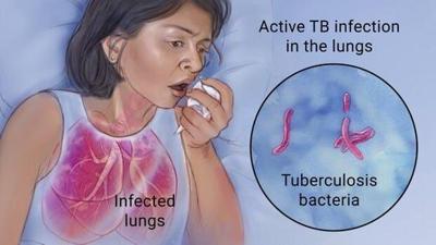 Active Tuberculosis Found in a Sussex County School