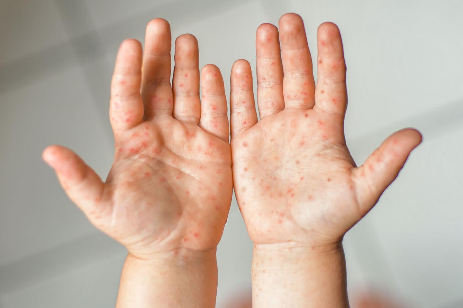 Delaware measles cases rise to 8, all confirmed in Kent County