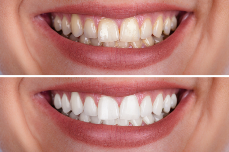 dentitox pro ingredients