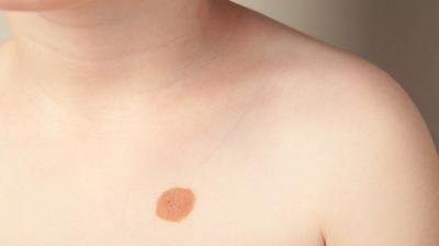 Moles vs. birthmarks: What's normal and what warrants a check
