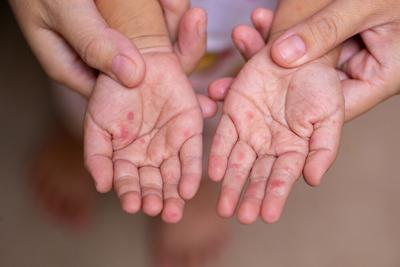 Measles