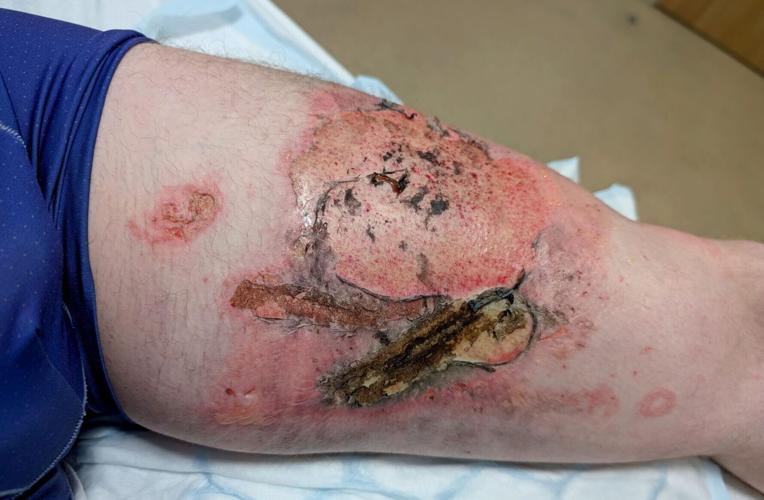 Man suffers serious burns to leg after vape battery explodes in his pocket