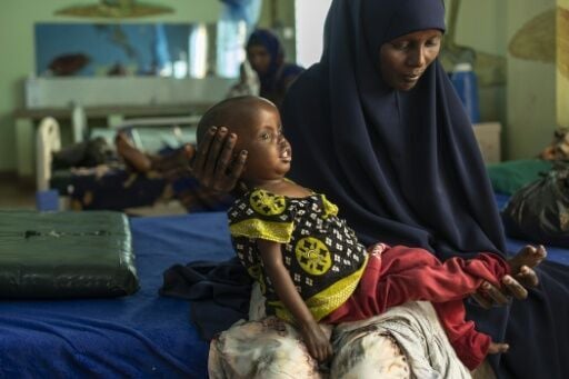 Children are suffering severe malnutrition due to the drought