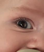 Mum thought baby’s “wonky” eye was adjusting  but it was rare cancer