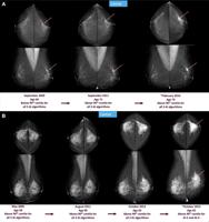 Breast cancer warning signs could be spotted up to six years in advance using AI
