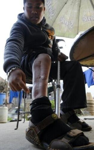 Former migrant worker Bhupendra Malla, whose legs were crushed on a construction site in Qatar