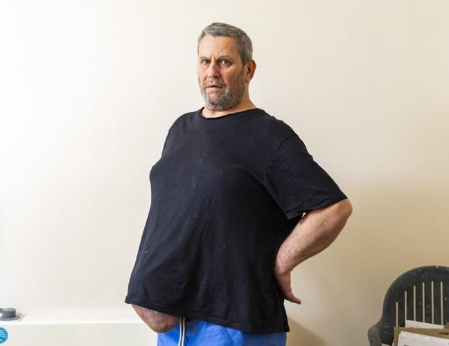 Man can’t get watermelon-sized hernia removed on NHS