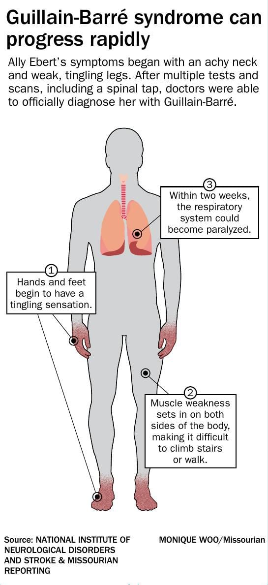 Guillain Barre Syndrome Can Progress Rapidly Visuals Columbiamissourian Com