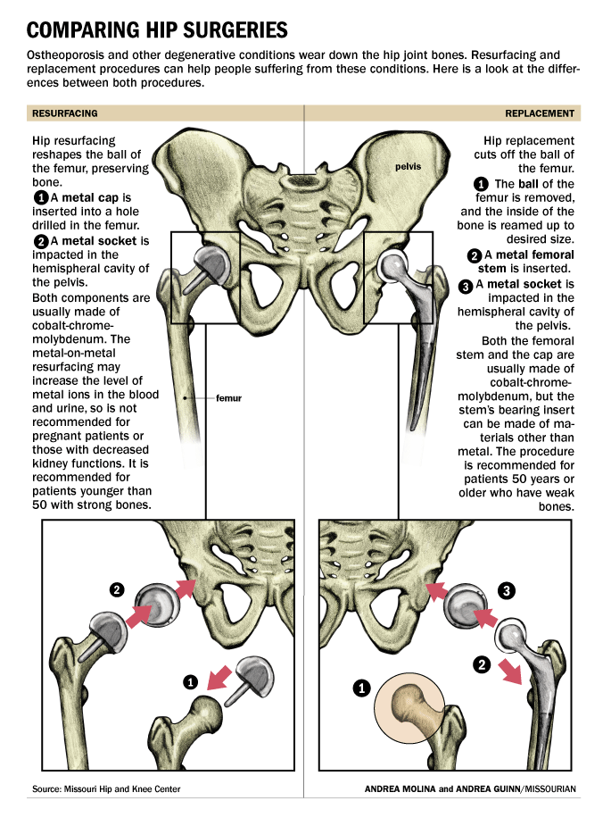 Patients wear down their artificial hips