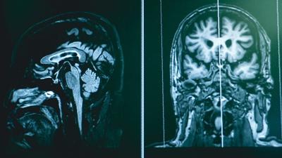 The early signs of frontotemporal dementia