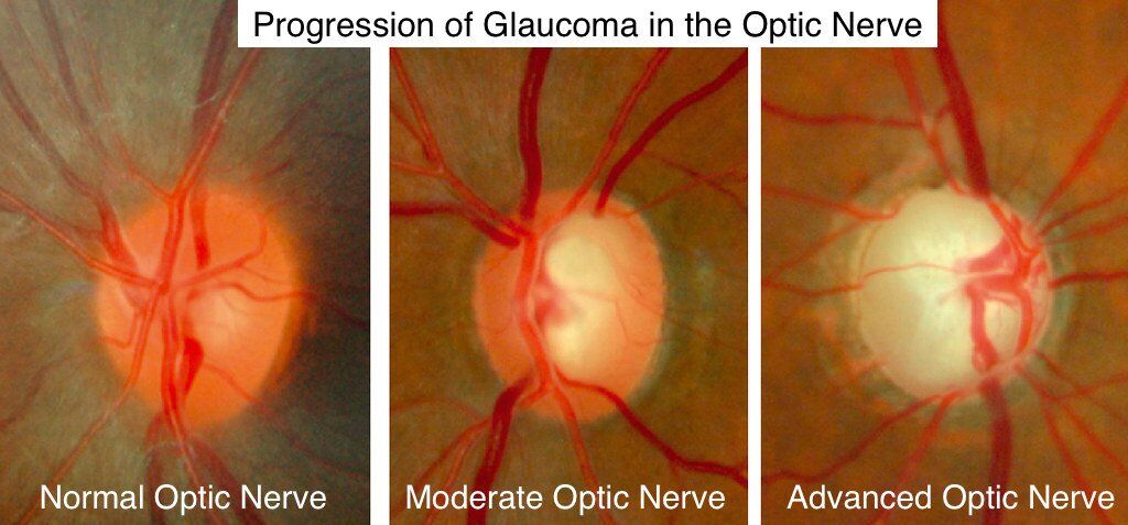 Glaucoma progression