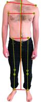 Dr. Nick Araza: Is your short leg causing your back pain?