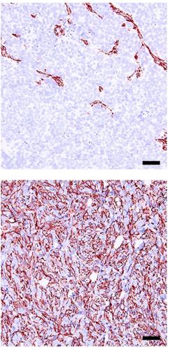 Prostate cancer treatment breakthrough could boost survival rates
