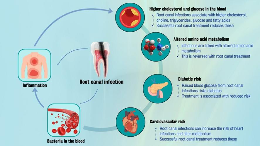 Root canal infection – 1