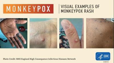 15 cases of Moneypox in Nh