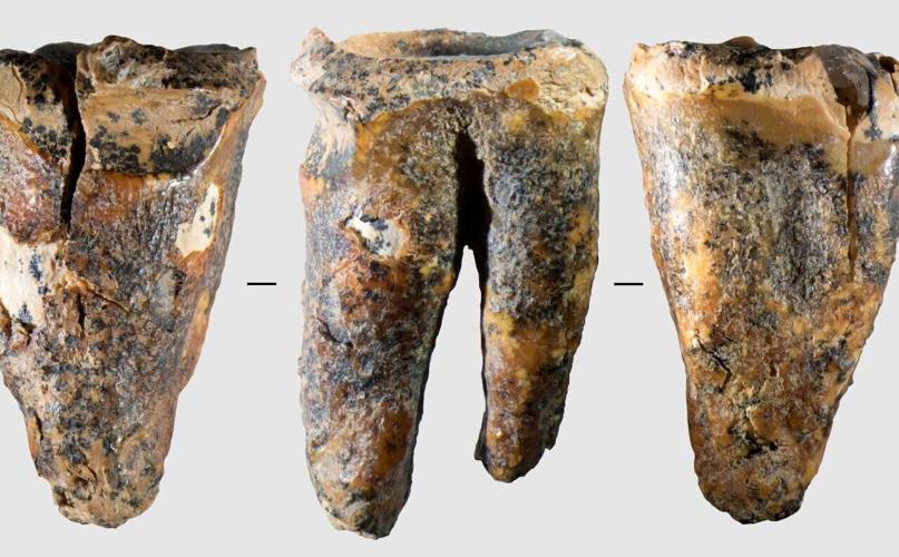 Tooth shows cavemen conducted dental surgery thousands of years before anaesthetic