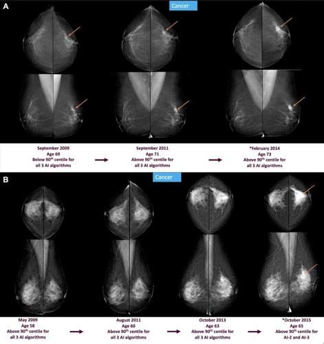Breast cancer warning signs could be spotted up to six years in advance using AI