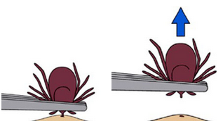 tick-removal-unh.png