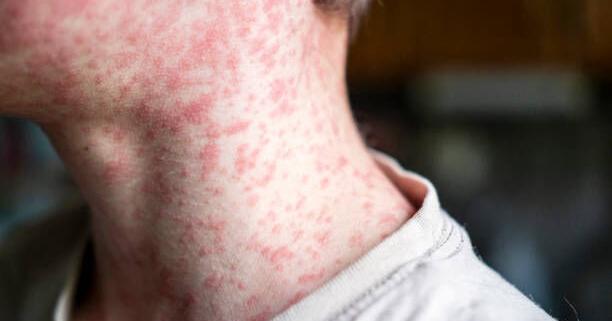 Measles outbreak in Buckingham County hits new high