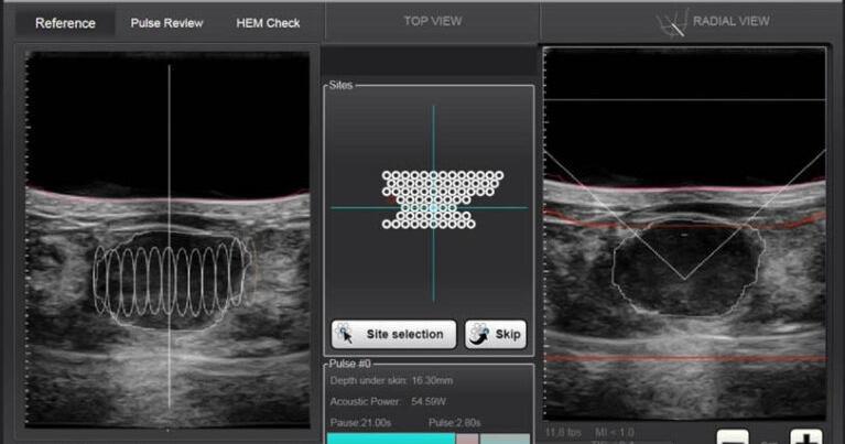 New breast cancer treatment 'on the cusp' of FDA approval, UVa experts say - Vimarsana News