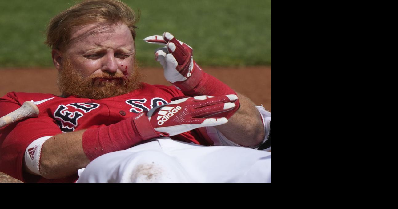 Red Sox Star Justin Turner Needs 16 Stitches In Face After Being