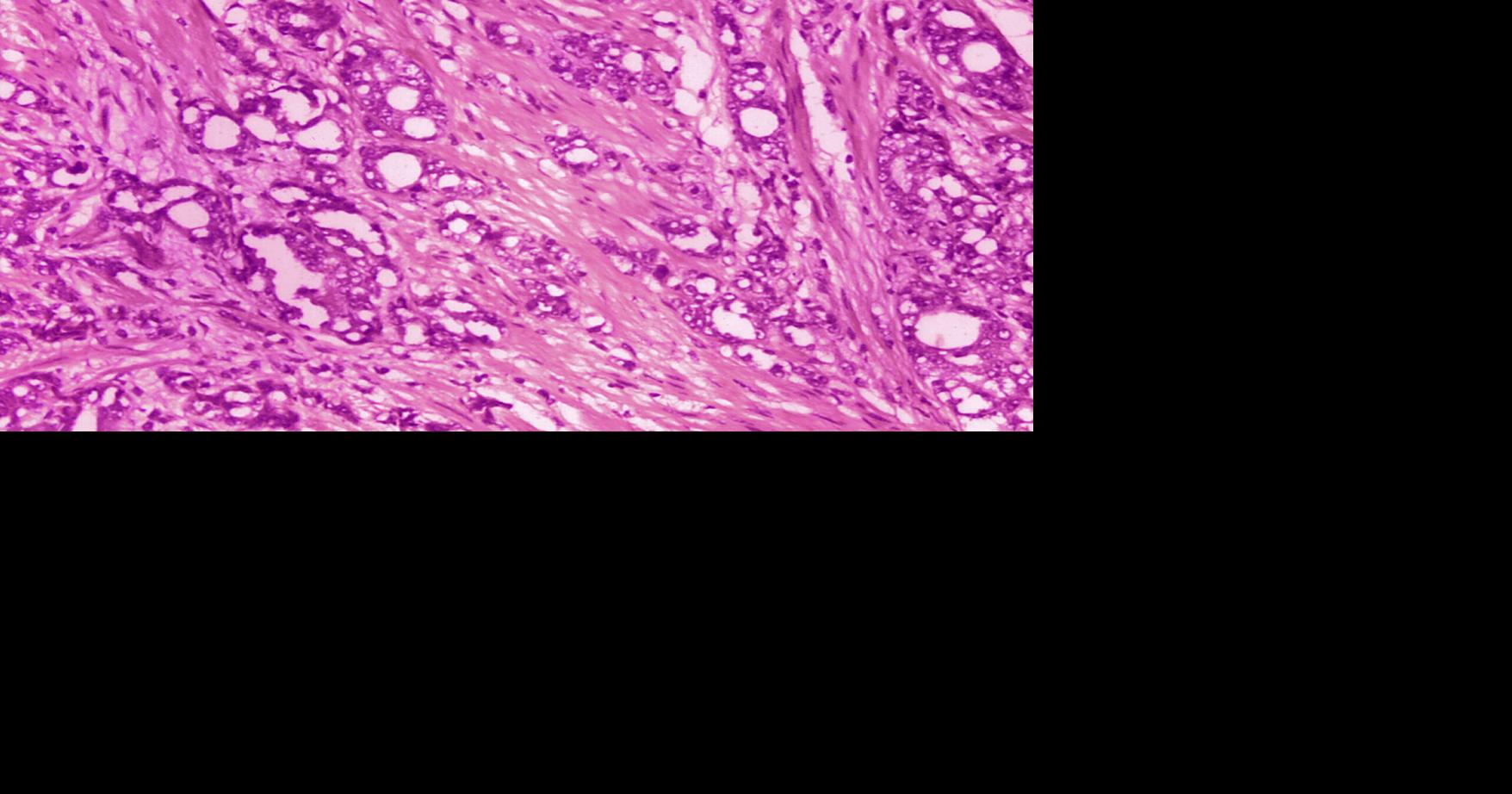 Cal Thomas: Prostate cancer demands early detection, not denial