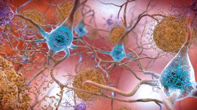 Fármaco experimental contra Alzheimer logra la involución de la enfermedad