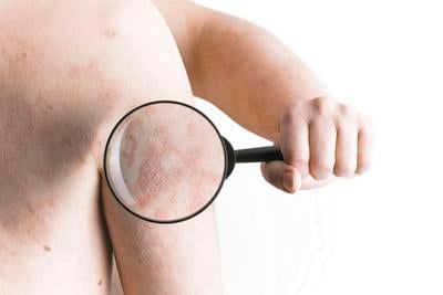 Conoce sobre las enfermedades inflamatorias que se reflejan en la piel