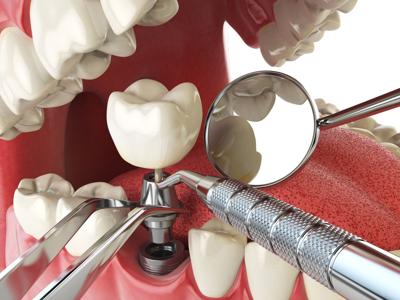 Encarecen los implantes dentales