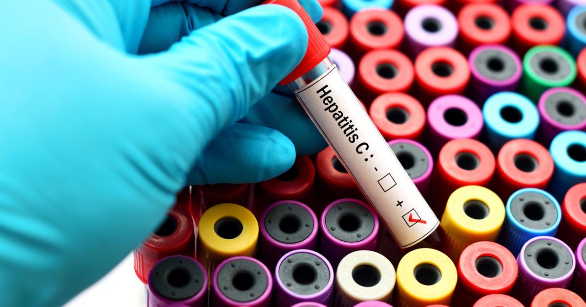 Más de 100 laboratorios ofrecerán pruebas gratuitas de hepatitis C en 42 municipios