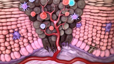 Prueban novedosa terapia para melanoma avanzado
