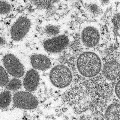 Israel reporta su primer caso de viruela símica
