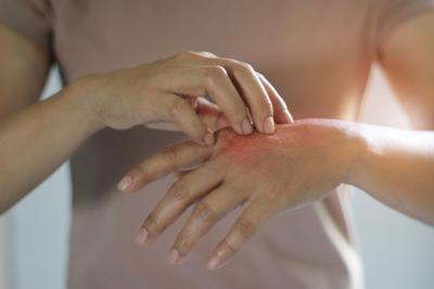 ¿Cómo manejar la psoriasis en pacientes de artritis?