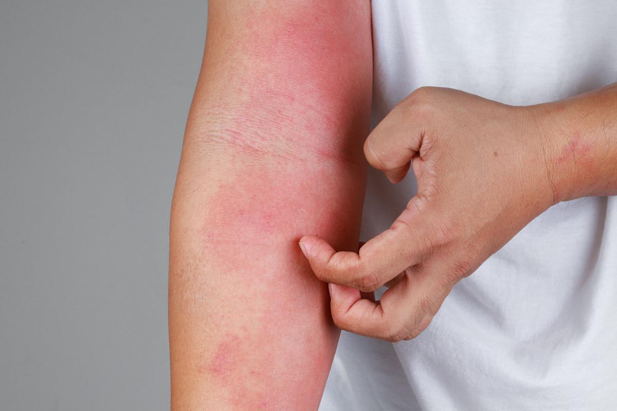 Dermatitis seborreica - Síntomas y causas - Mayo Clinic