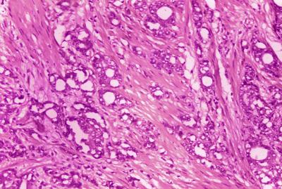 Tratamiento para el cáncer de próstata puede esperar