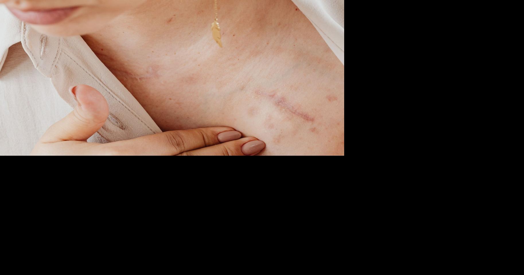 FDA aprueba aceleradamente Zenbexus, nueva terapia para el mieloma múltiple