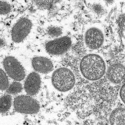 Detectan en Florida un posible caso de "monkeypox"