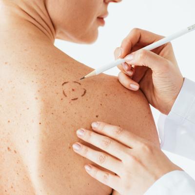 Detecta a tiempo el cáncer de piel