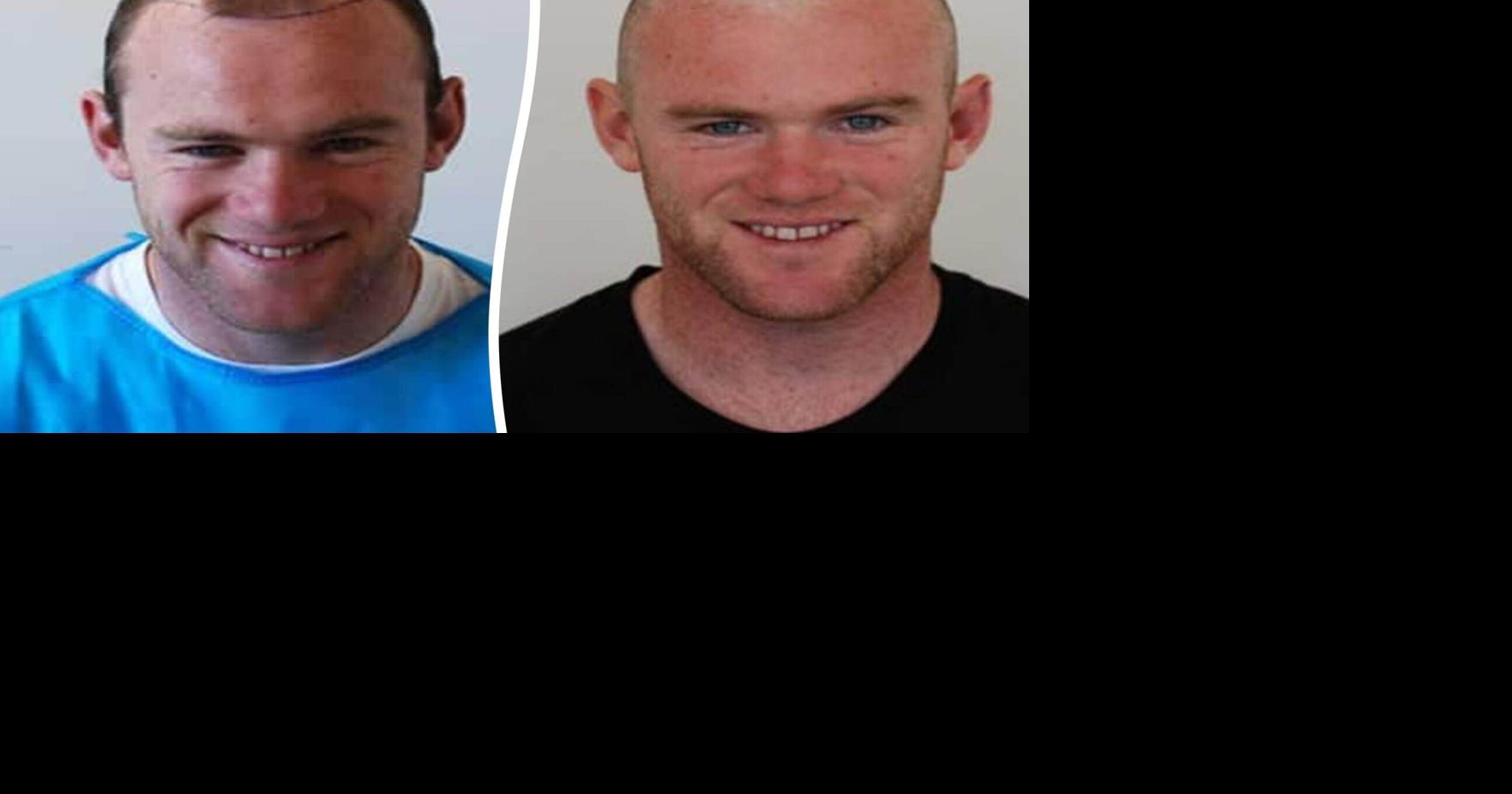 Clinic behind Wayne Rooney’s hair transplant gets 5 requests a day for the ‘Rooney’