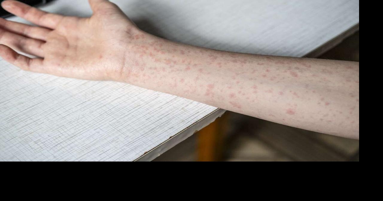 More measles cases reported in Northern Virginia