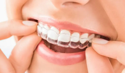 Teeth Alignment Cost: Braces, In-Office & At-Home Options