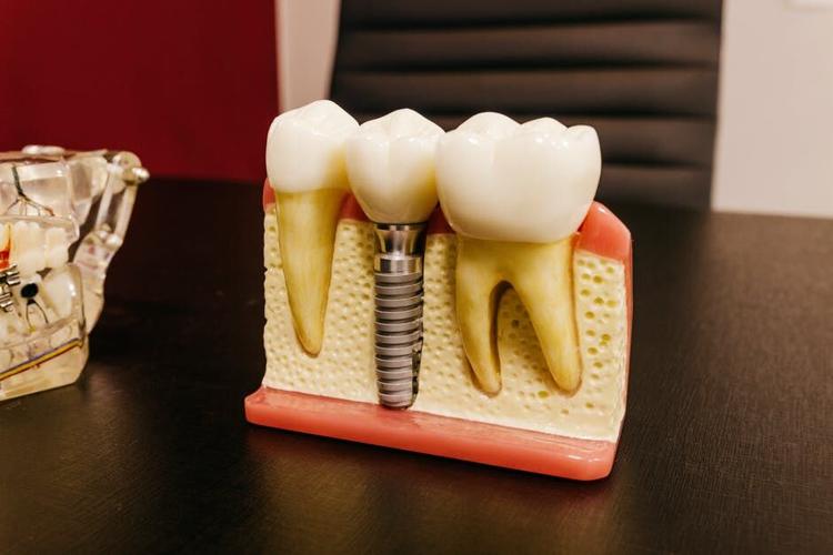 The Complete Guide to Dental Implants and How They Can Transform Your Smile