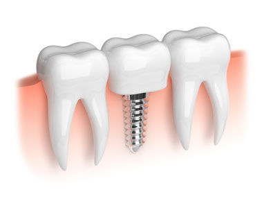 Are Dental Implants Right For You? These 5 Signs Say Yes!